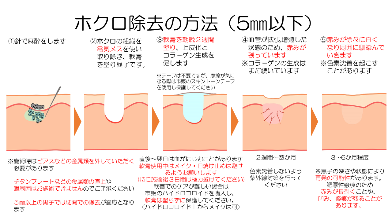 黒子除去について | UBCLINIC立川